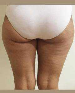 cryolipolysis