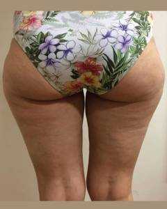 cryolipolysis