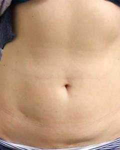 cryolipolysis