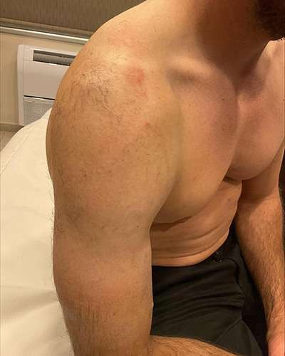 Tattoo Removal Before After