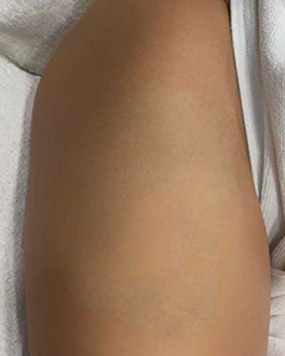 Tattoo Removal Before After