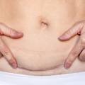 C-Section Scar Laser Treatment in Limassol