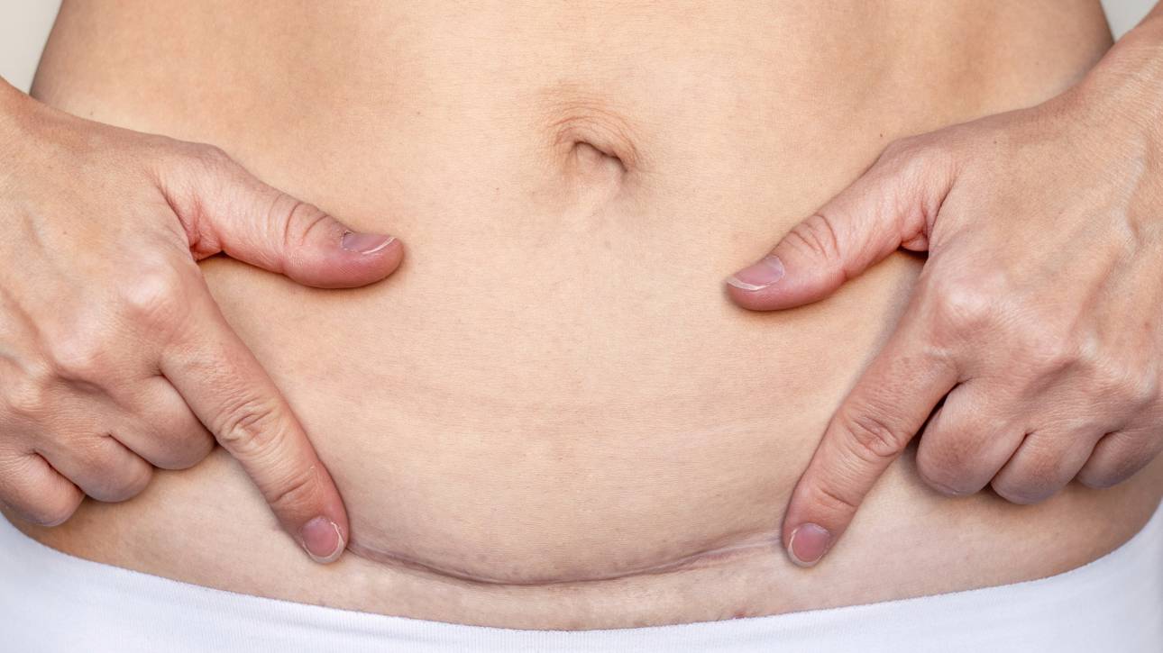 -Section Scar Laser Treatment in Limassol