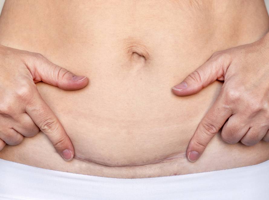 -Section Scar Laser Treatment in Limassol